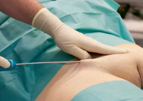 Fig 9. Lipoaspiración del monte de Venus por incisión lateral